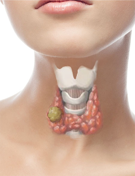 Nodulo tiroideo