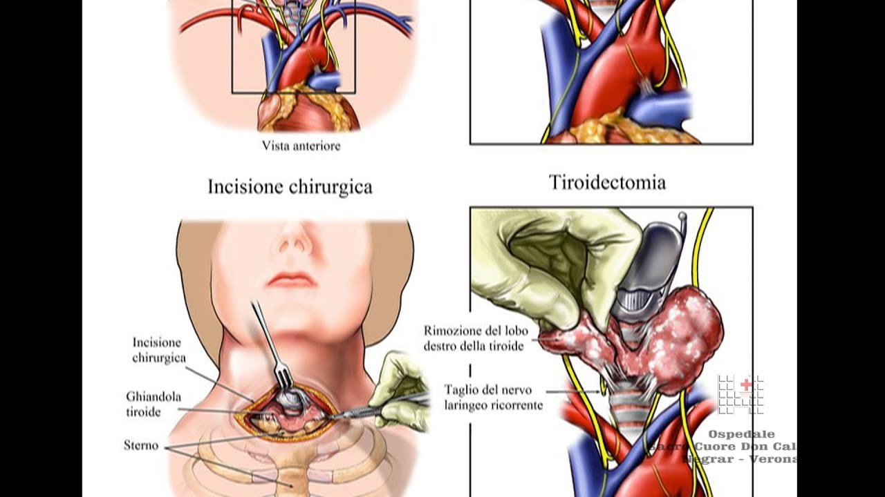 Tiroidectomia - Chirurgia della tiroide